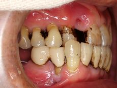 歯周病はプラーク（歯周病菌）が大きな原因です2